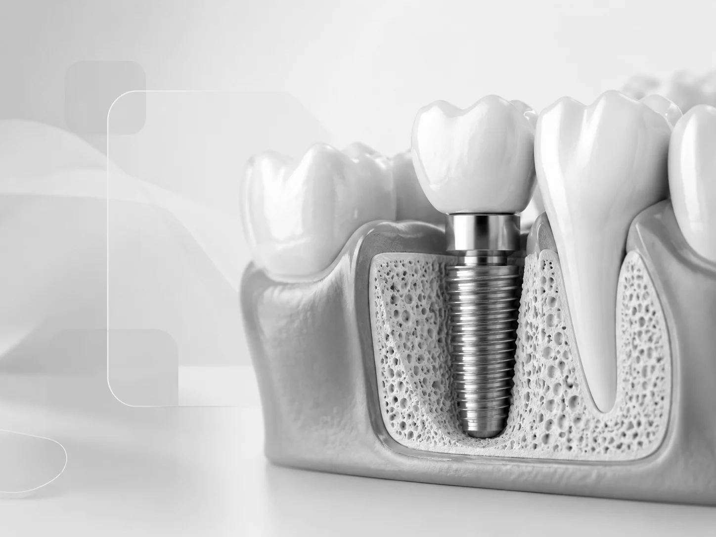 Detalle de implante dental en el maxilar