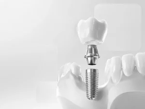 Implantologia dental implantes dentales valencia 3