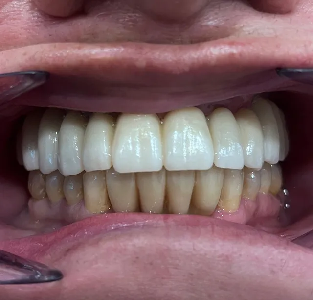 Rastauracion con implantes dentales y coronas de zirconio despues