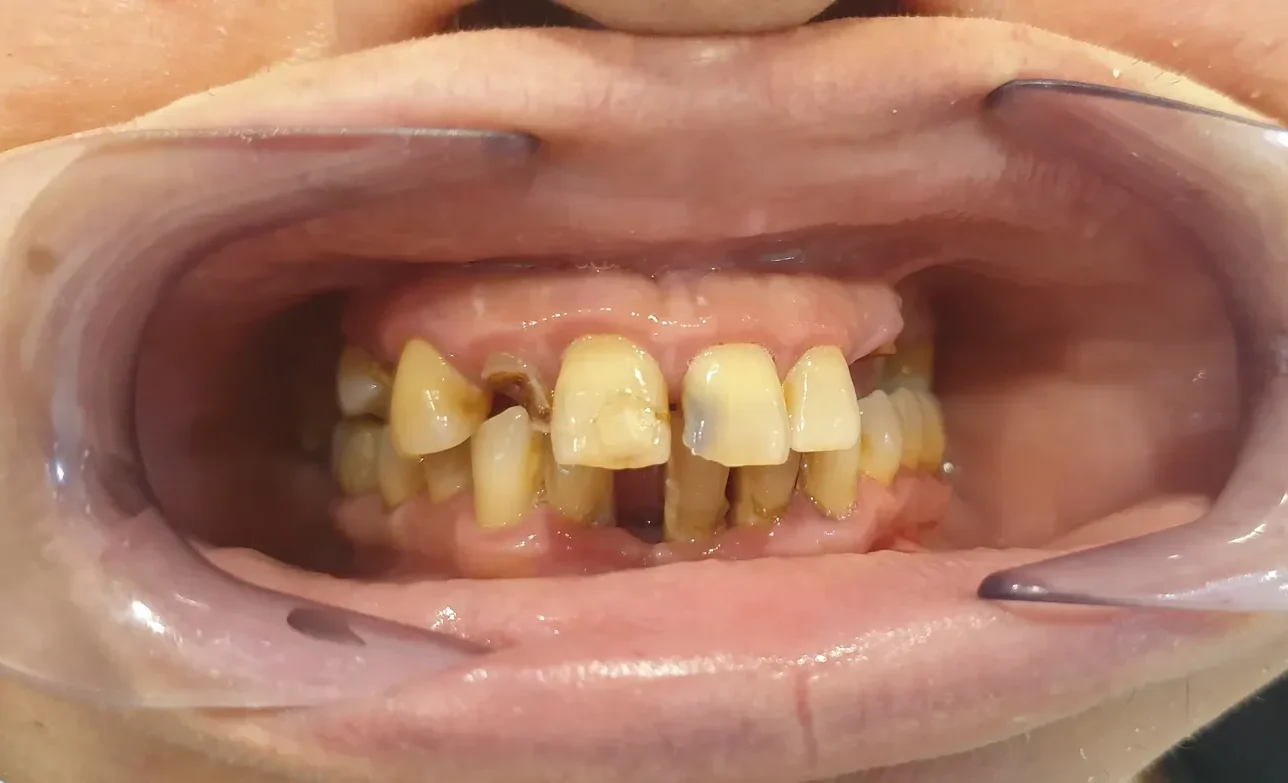 Antes - Restauración con implantes y coronas de zirconio