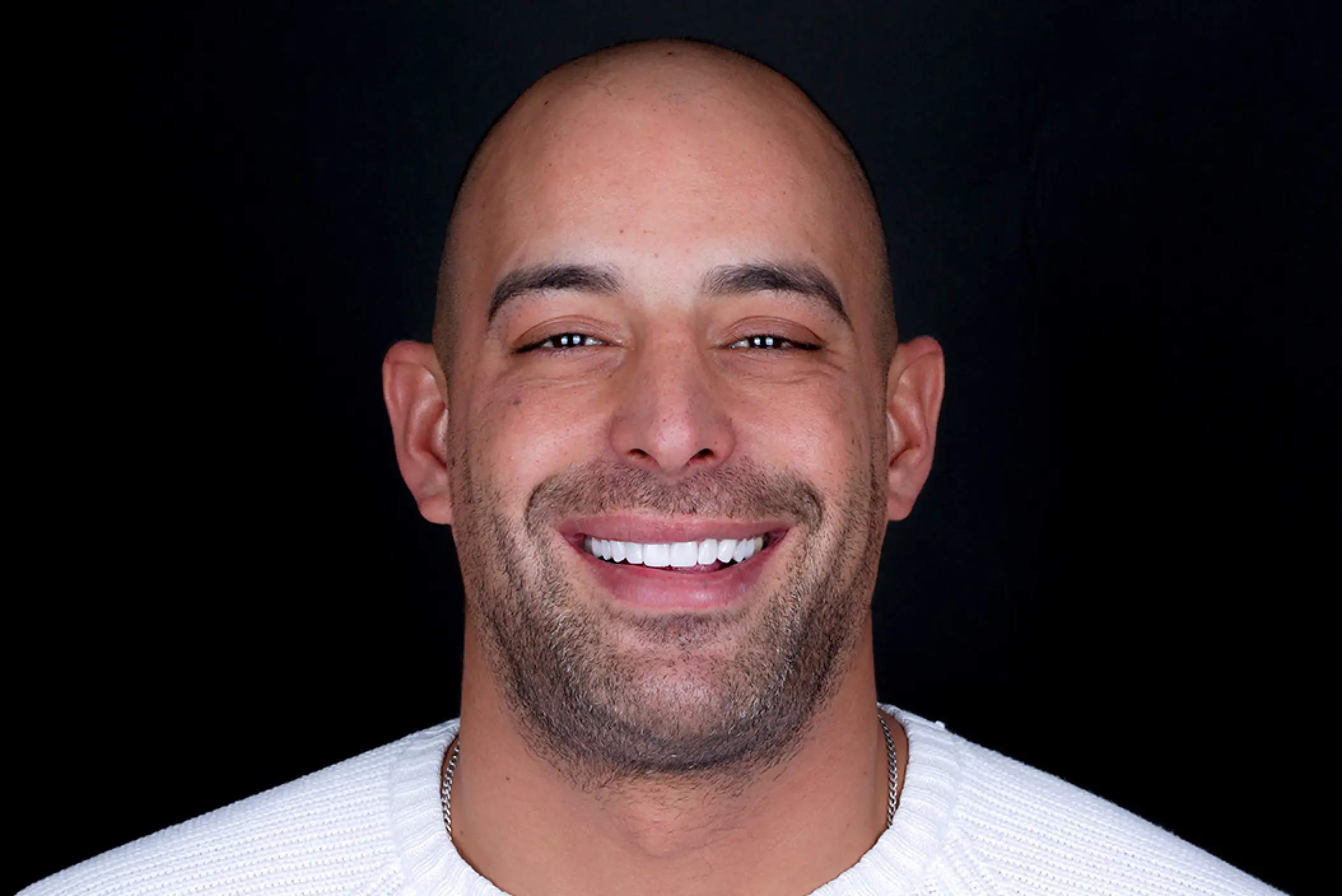 Casos reales de transformación de sonrisa - Clínica Dental Charani