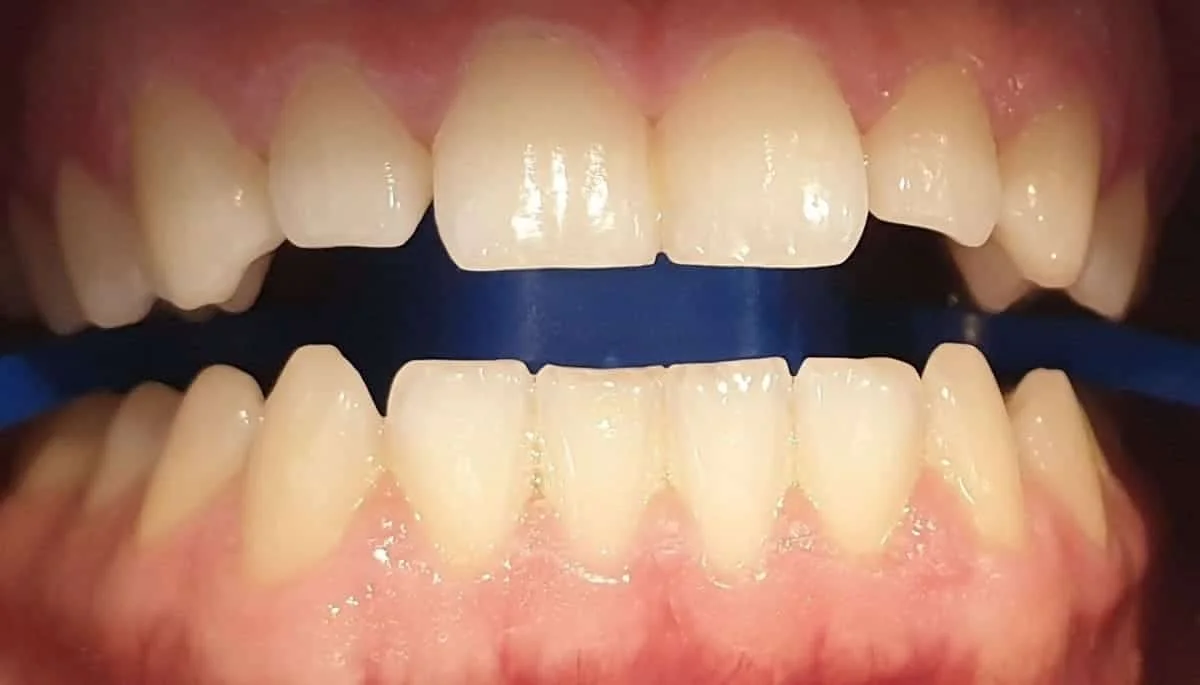 Antes - Blanqueamiento dental Philips Zoom