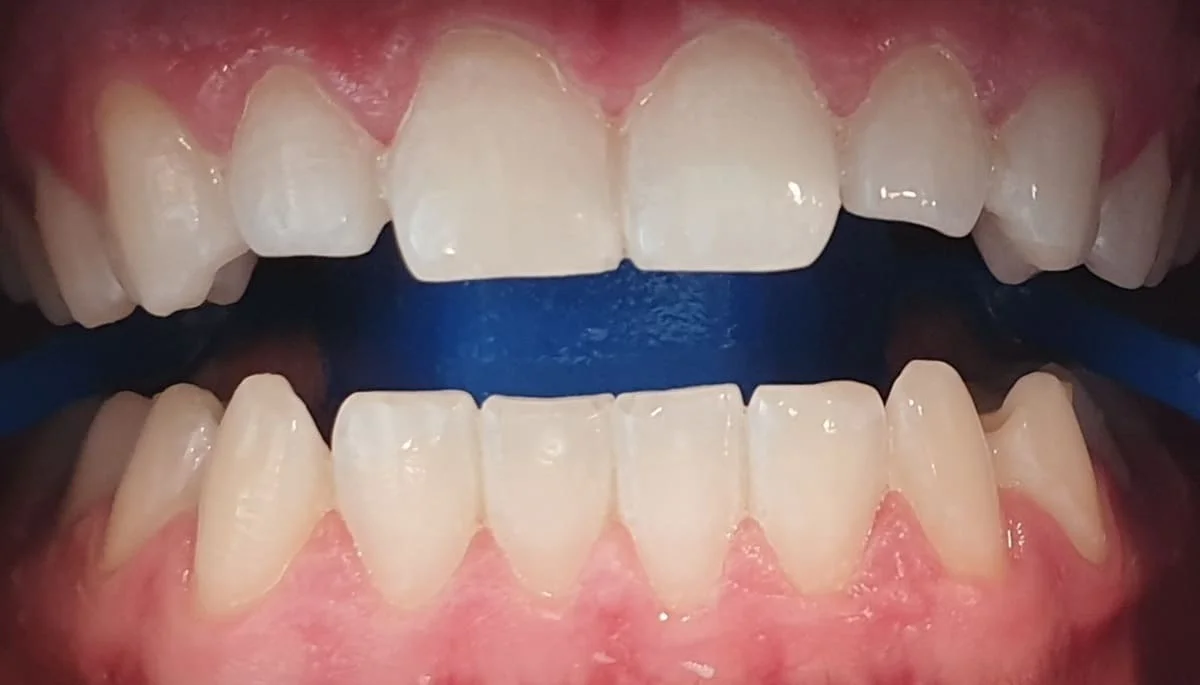 Después - Blanqueamiento dental Philips Zoom