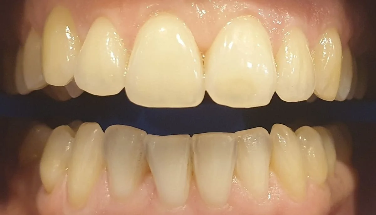 Antes - Blanqueamiento dental Philips Zoom