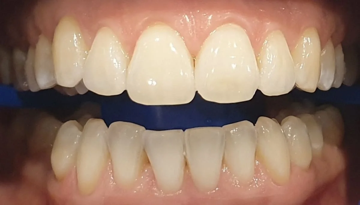 Después - Blanqueamiento dental Philips Zoom
