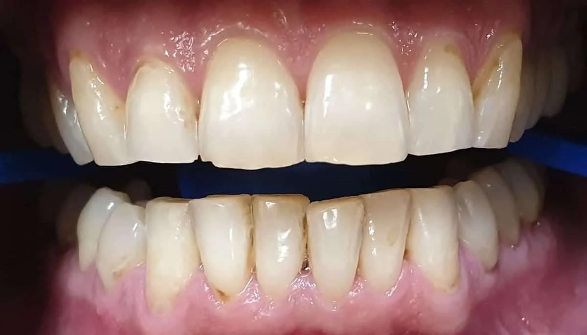 Antes - Blanqueamiento dental Philips Zoom