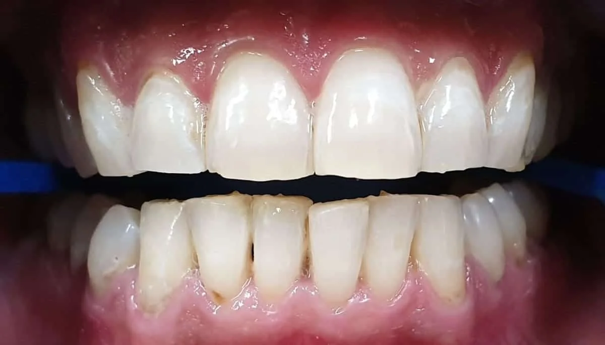 Después - Blanqueamiento dental Philips Zoom