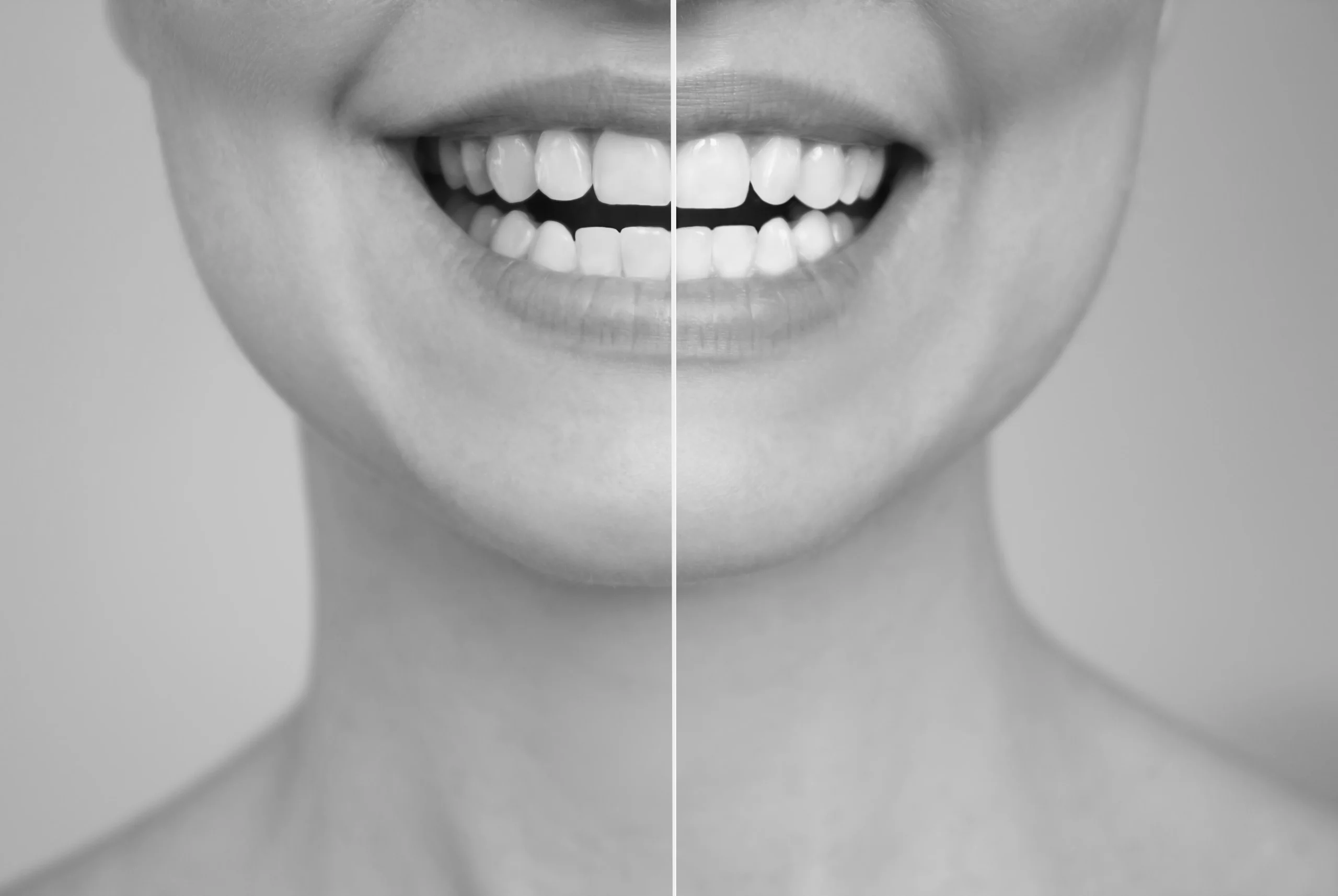 Blanqueamiento dental ambulatorio para dientes sensibles