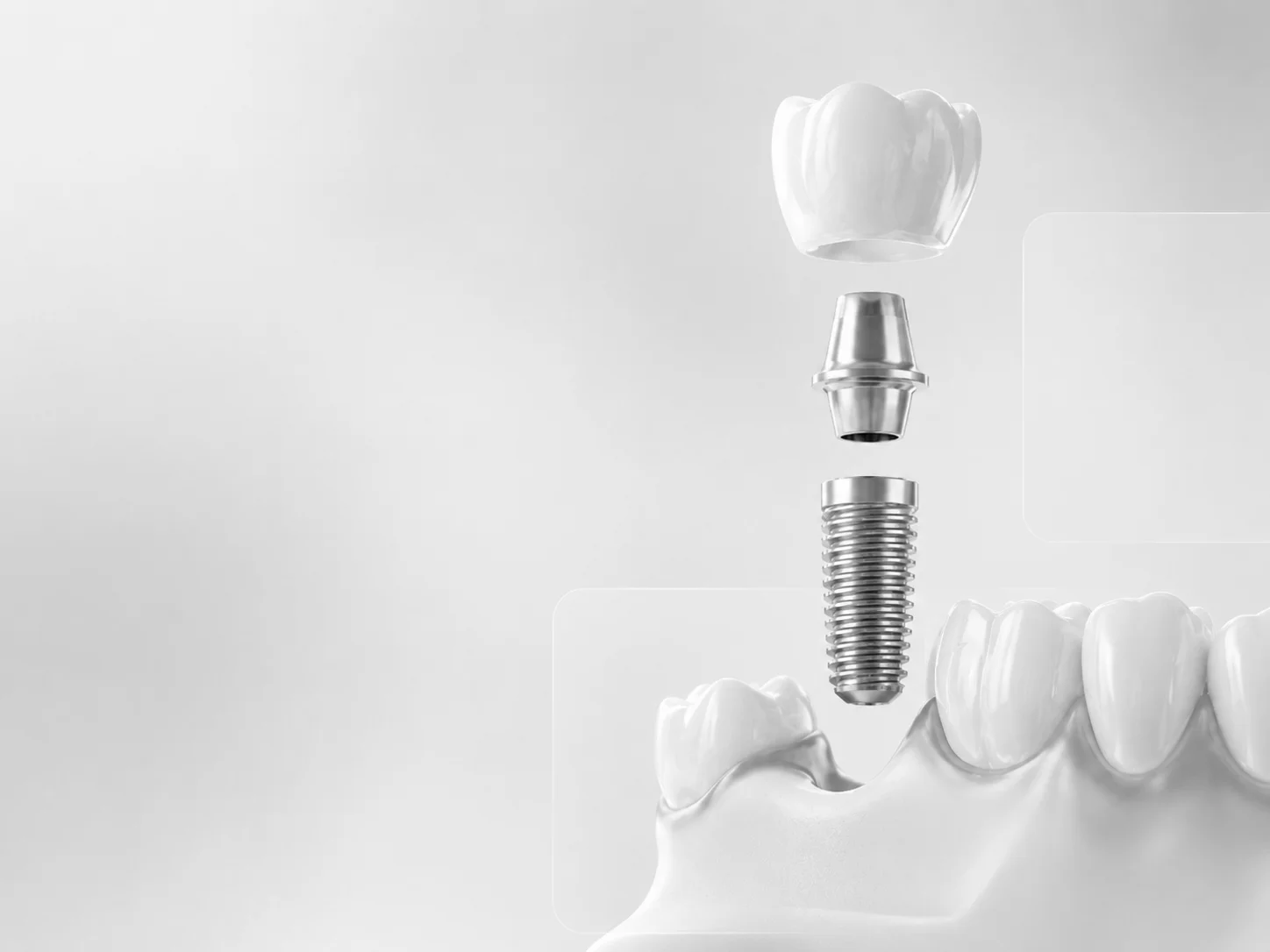 Cirugía e implantología dental en Valencia - Clínica Charani