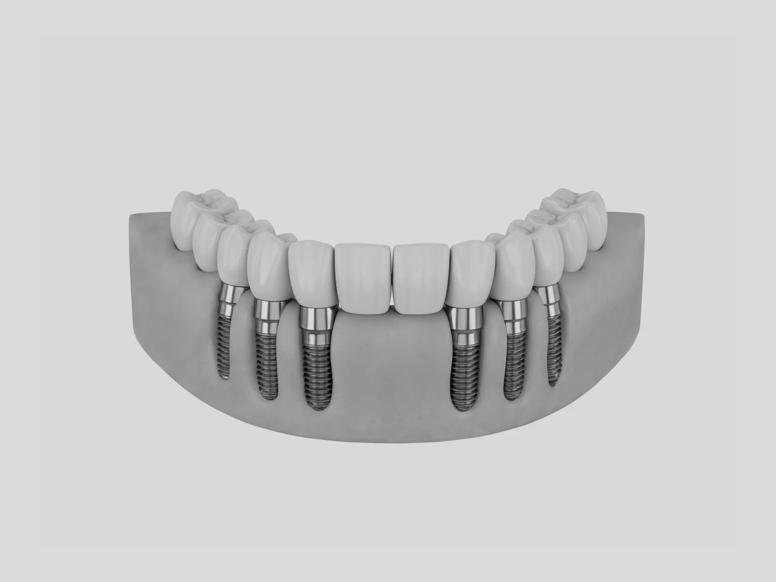 Prótesis de arcada completa fija sobre seis implantes en la encía, técnica All on Six
