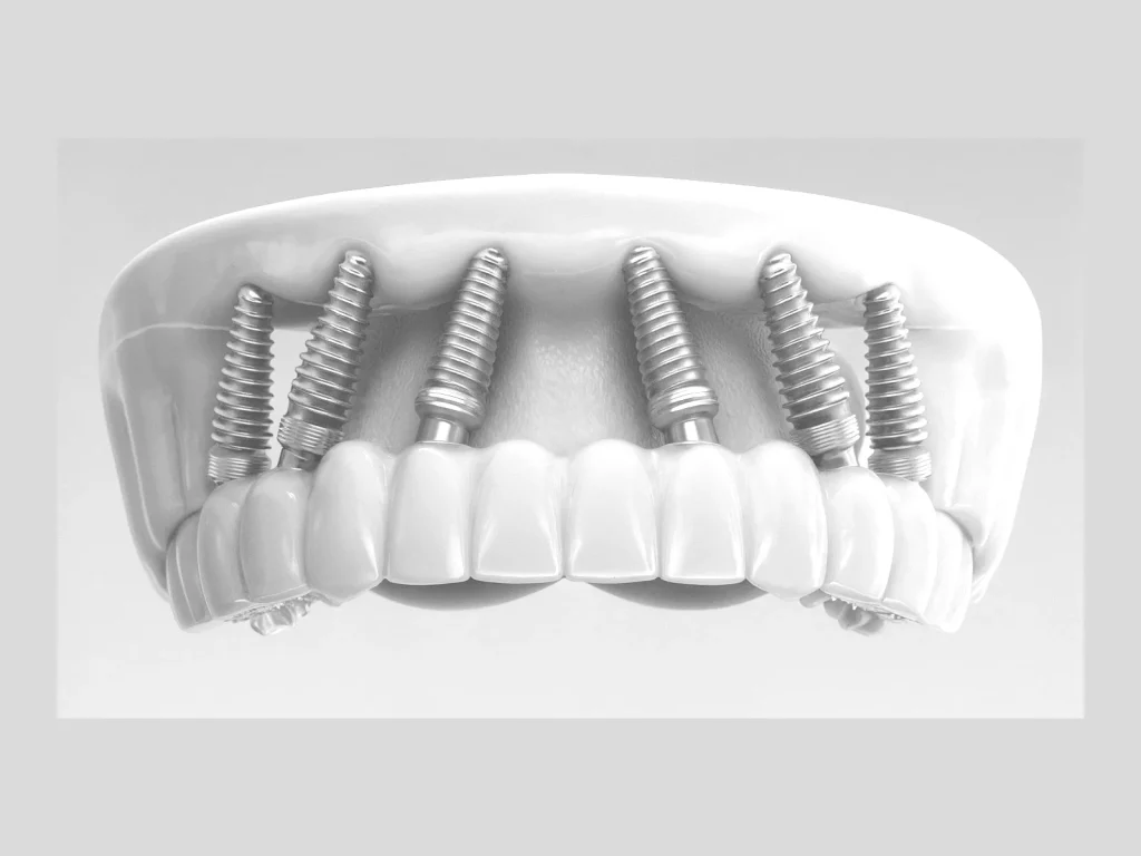 All on six seis implantes puente titanio