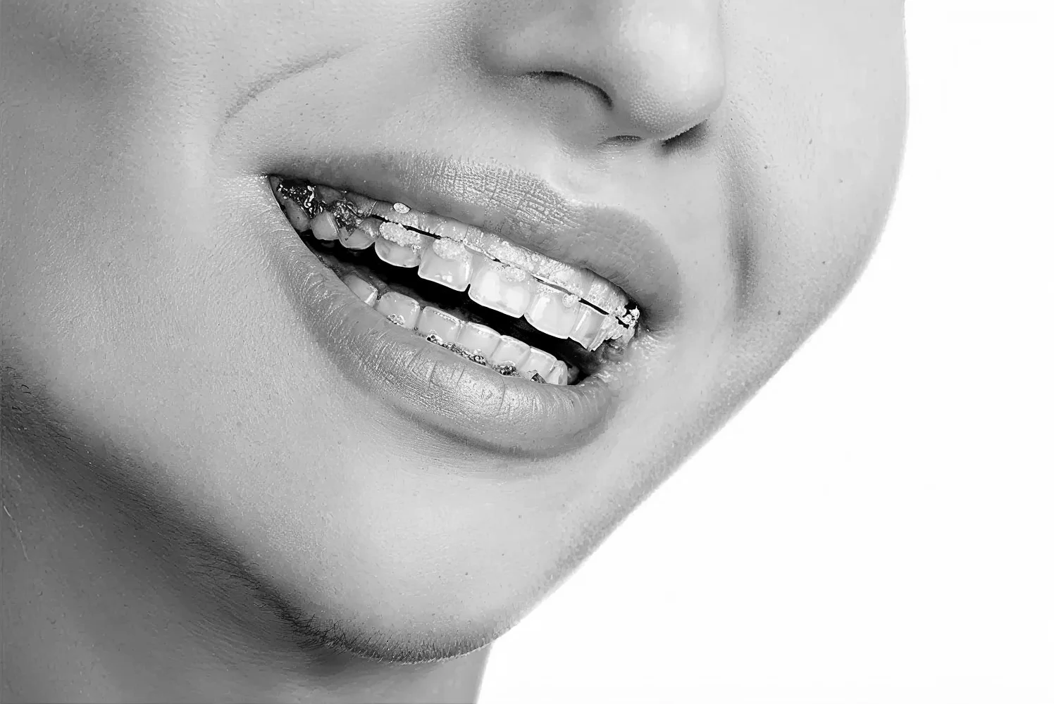 Aparatos dentales blancos sobre sonrisa bonita