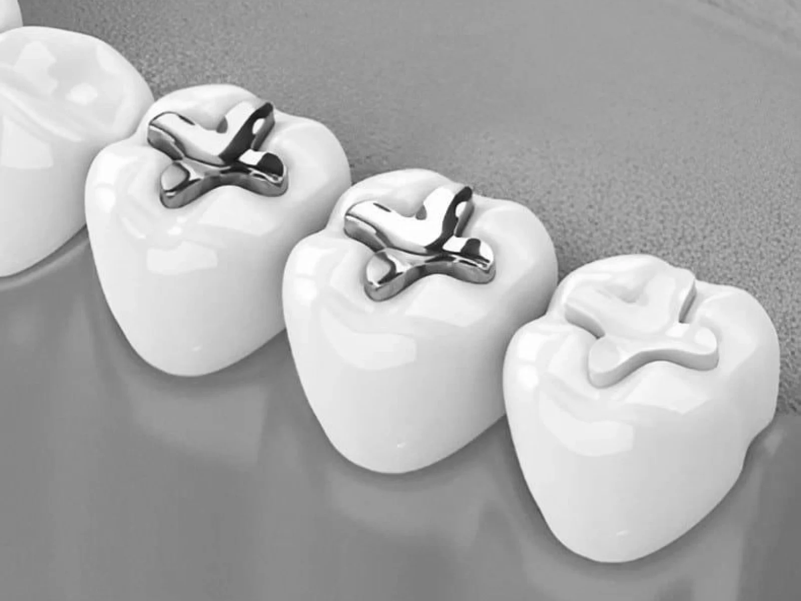 Modelo 3D con los tipos de empastes dentales