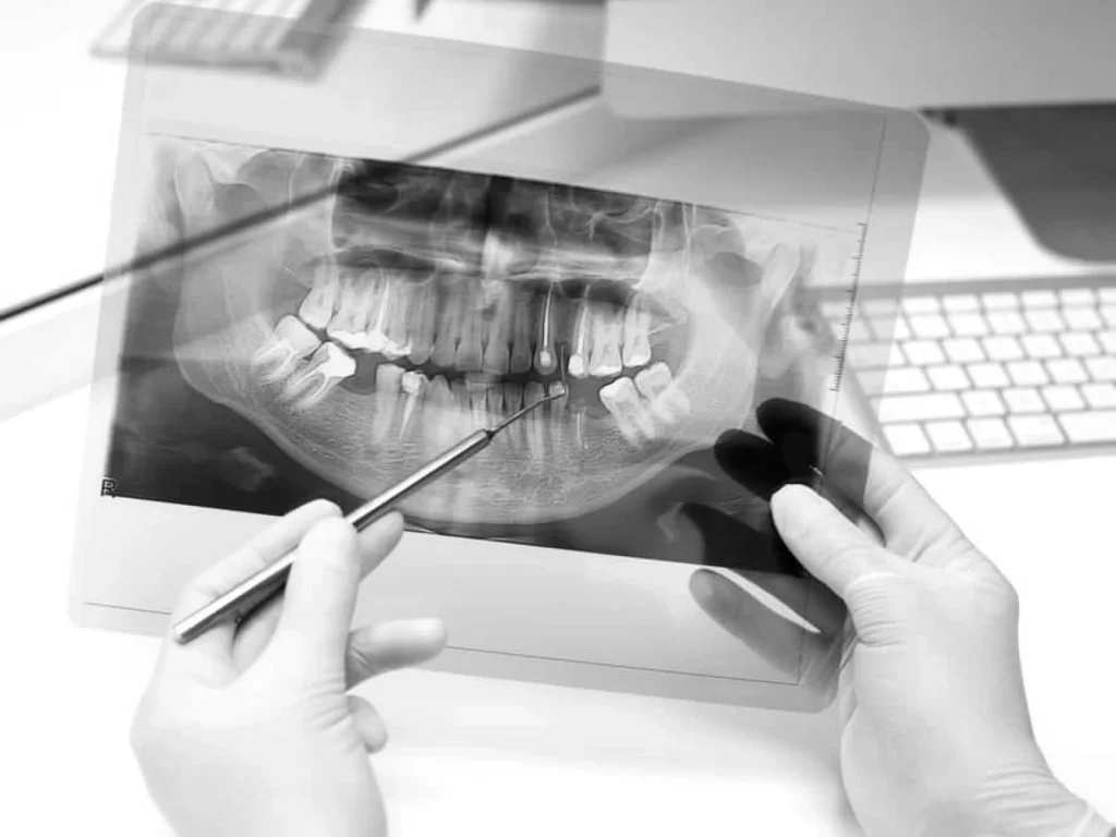 Endodoncia en valencia clinica dental charani