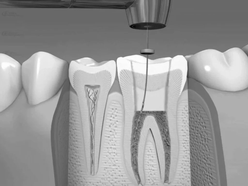 Endodoncia tratamiento conducto radicular valencia