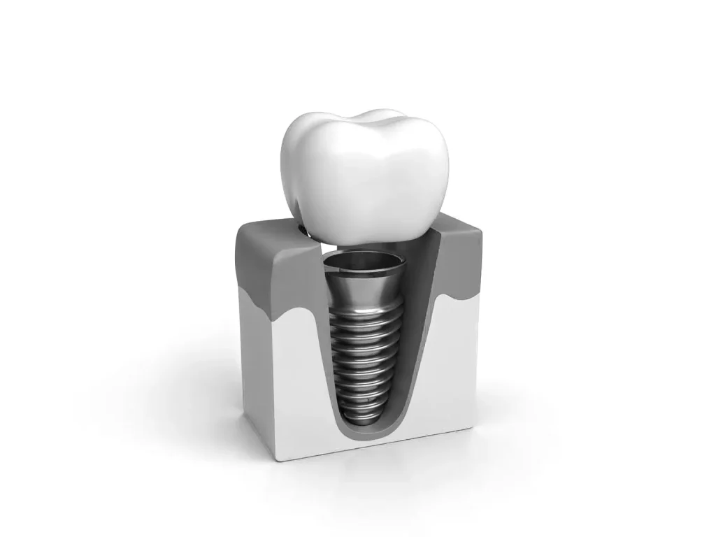 Implante dental integrado hueso tecnica sin cirugia