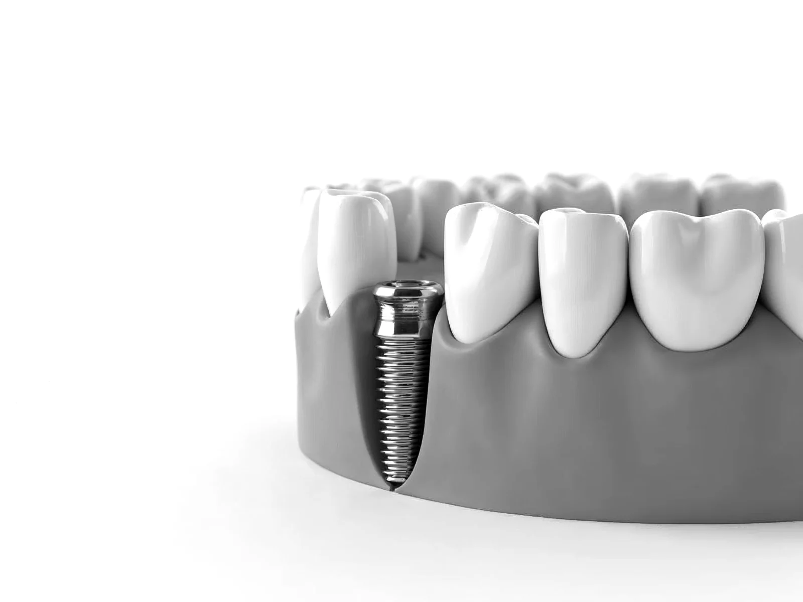 Implante dental sin cirugía, técnica mínimamente invasiva en Valencia