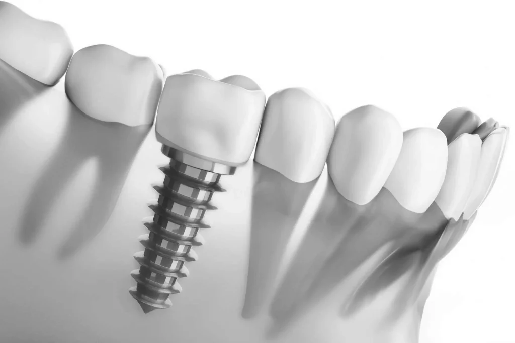 Implante dental tornillo diente
