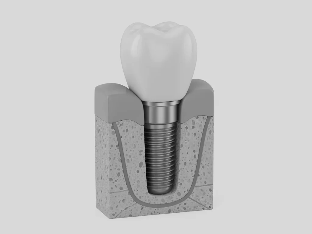 Implantes carga inmediata corona fija valencia