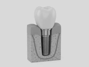 Implantes carga inmediata corona fija valencia