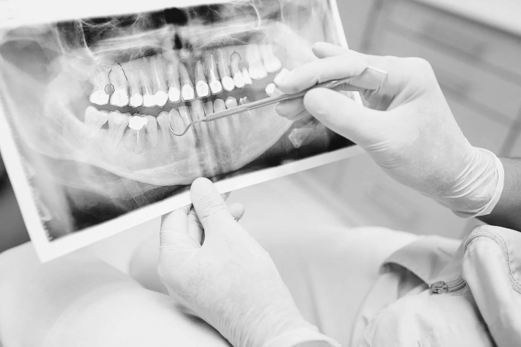 Implantes cortos clínica dental Doctor Charani