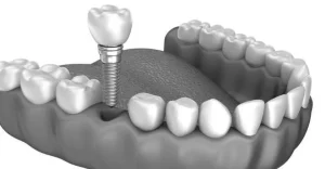 Implantes sin cirugia charani