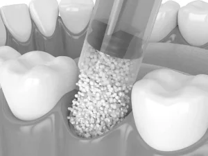 Injerto de hueso dental