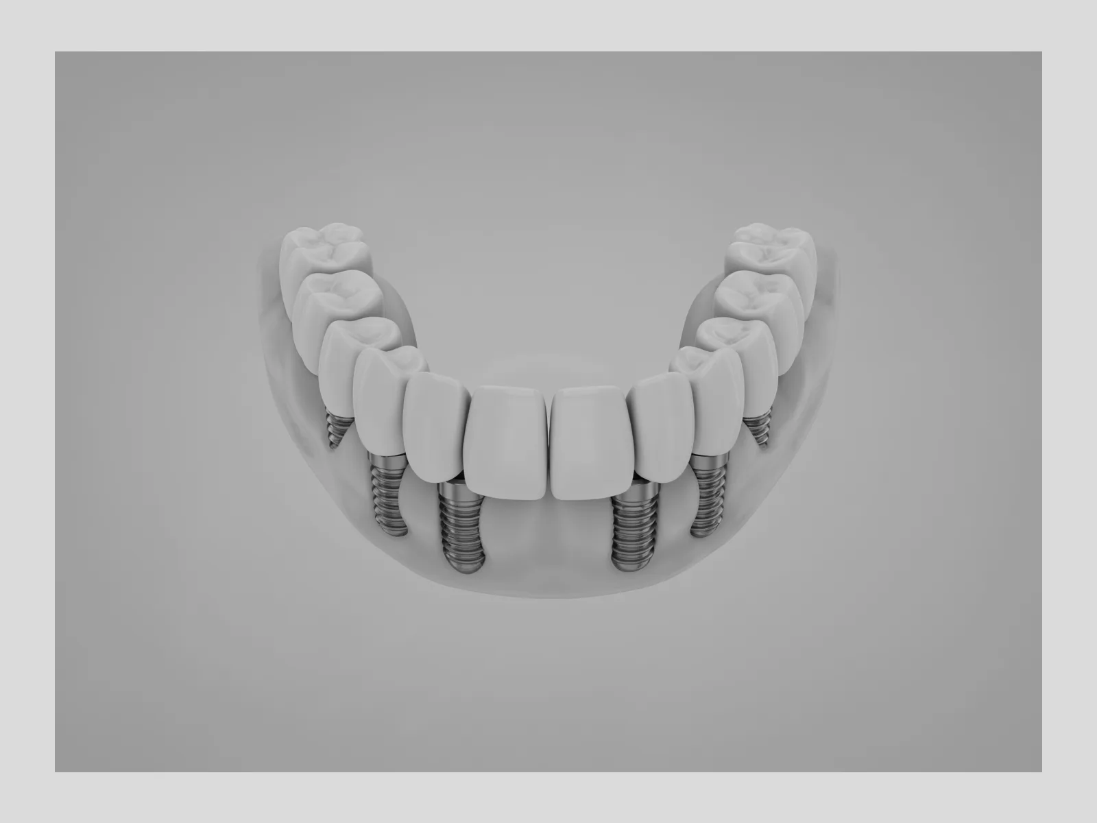 Arcada dental completa fija sobre implantes distribuidos, vista superior, técnica All on Six