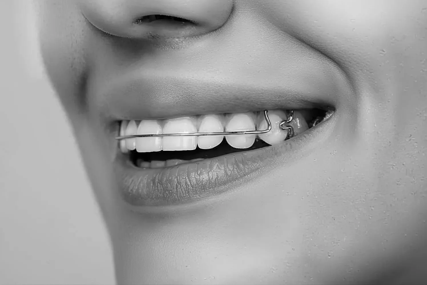 mujer con aparatos dentales de barra metálica