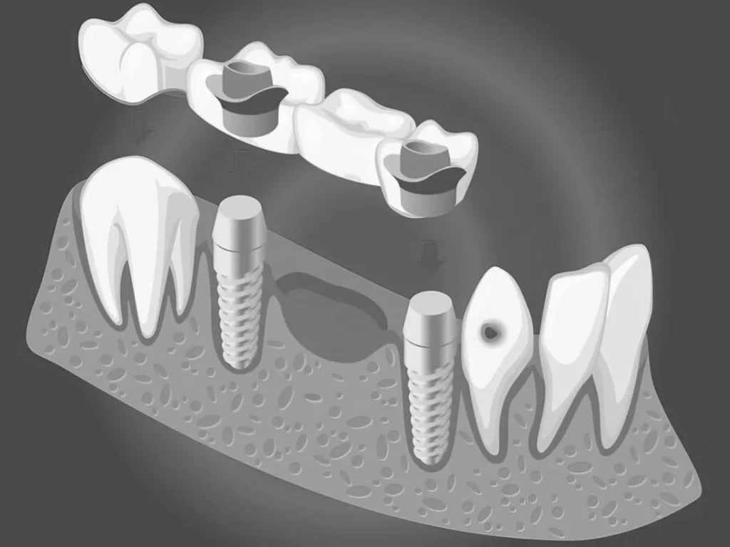 Puentes dentales 2