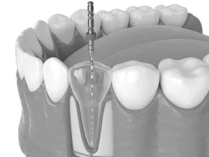 Reendodoncia