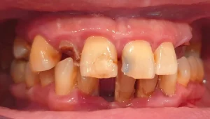 Restauracion completa con implantes dentales y coronas de circonio inicio