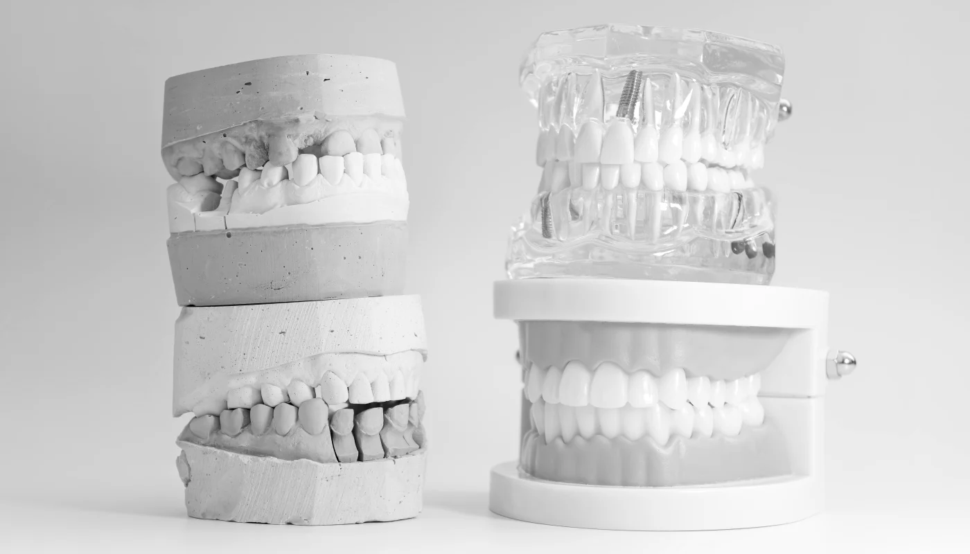 All-on-Six en Moncada - Clínica Dental Charani