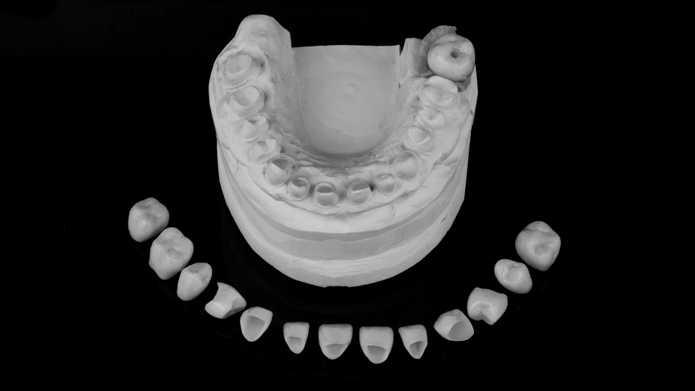 Implantes carga inmediata - Clínica Dental Charani