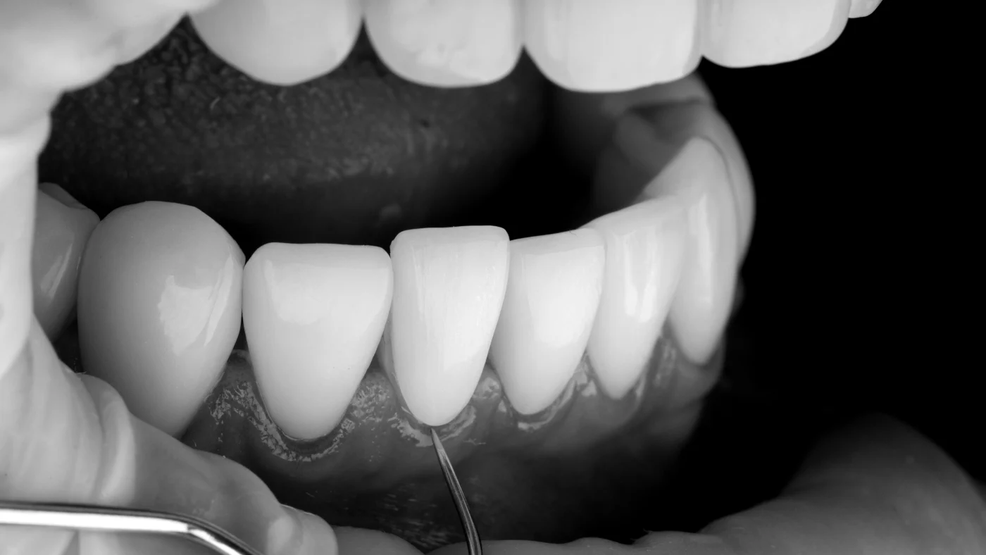 Implantes cortos en Rocafort - Clínica Dental Charani