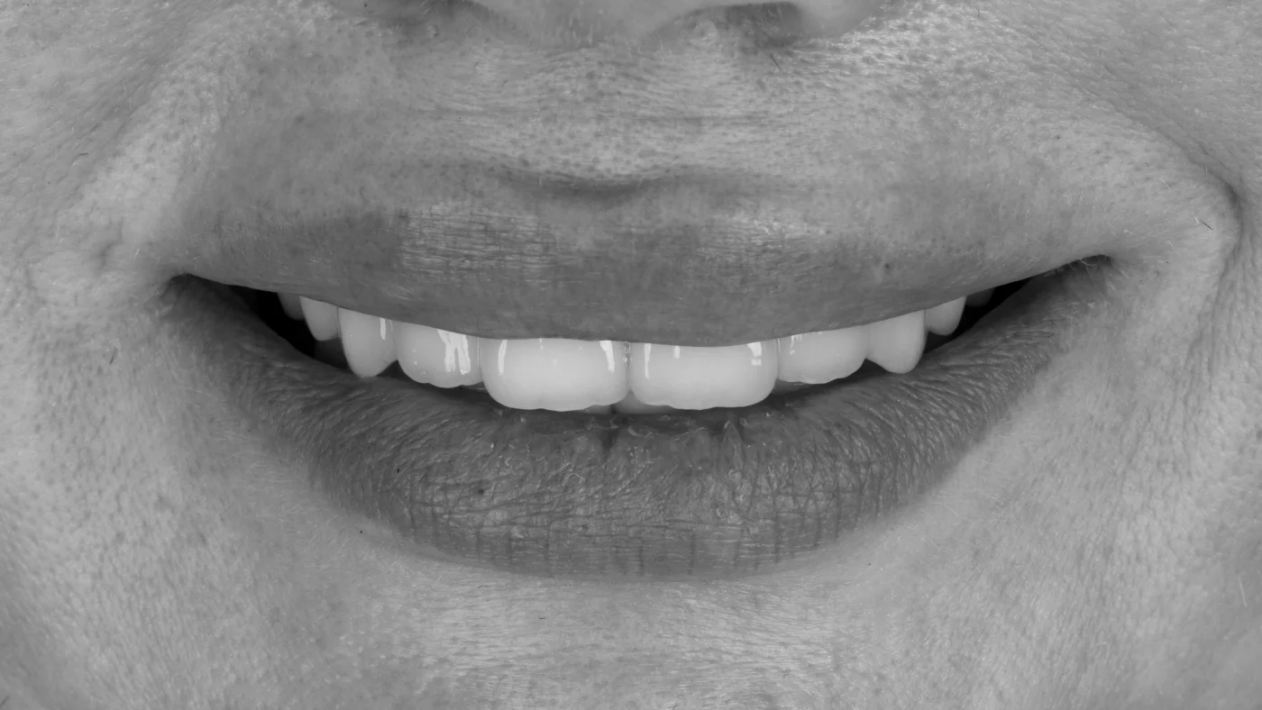 Implantes cortos en Rocafort - Clínica Dental Charani