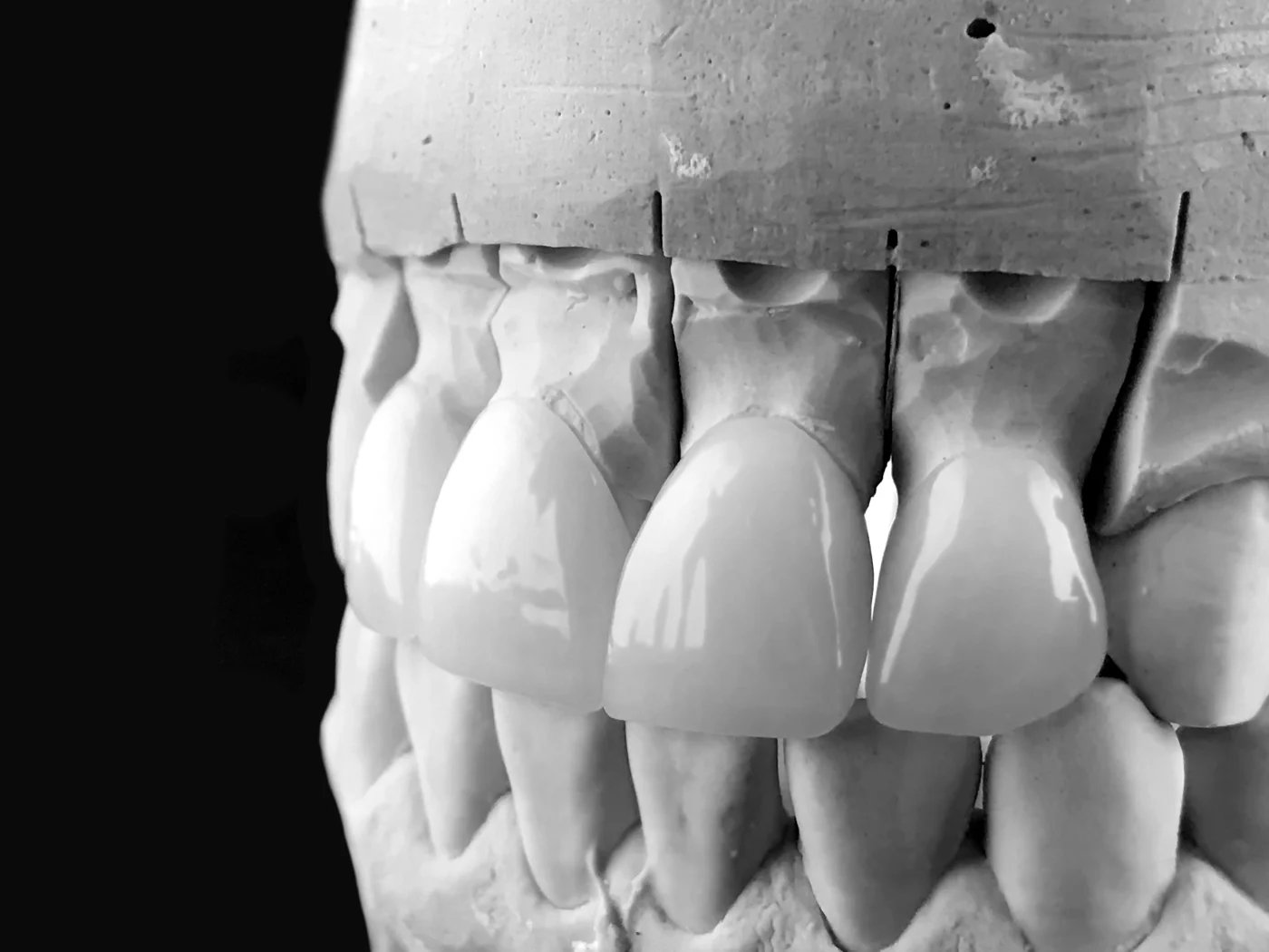 Implantes cortos en Rocafort - Clínica Dental Charani