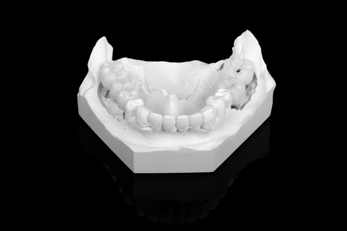 Implantes dentales en Alboraya - Clínica Dental Charani