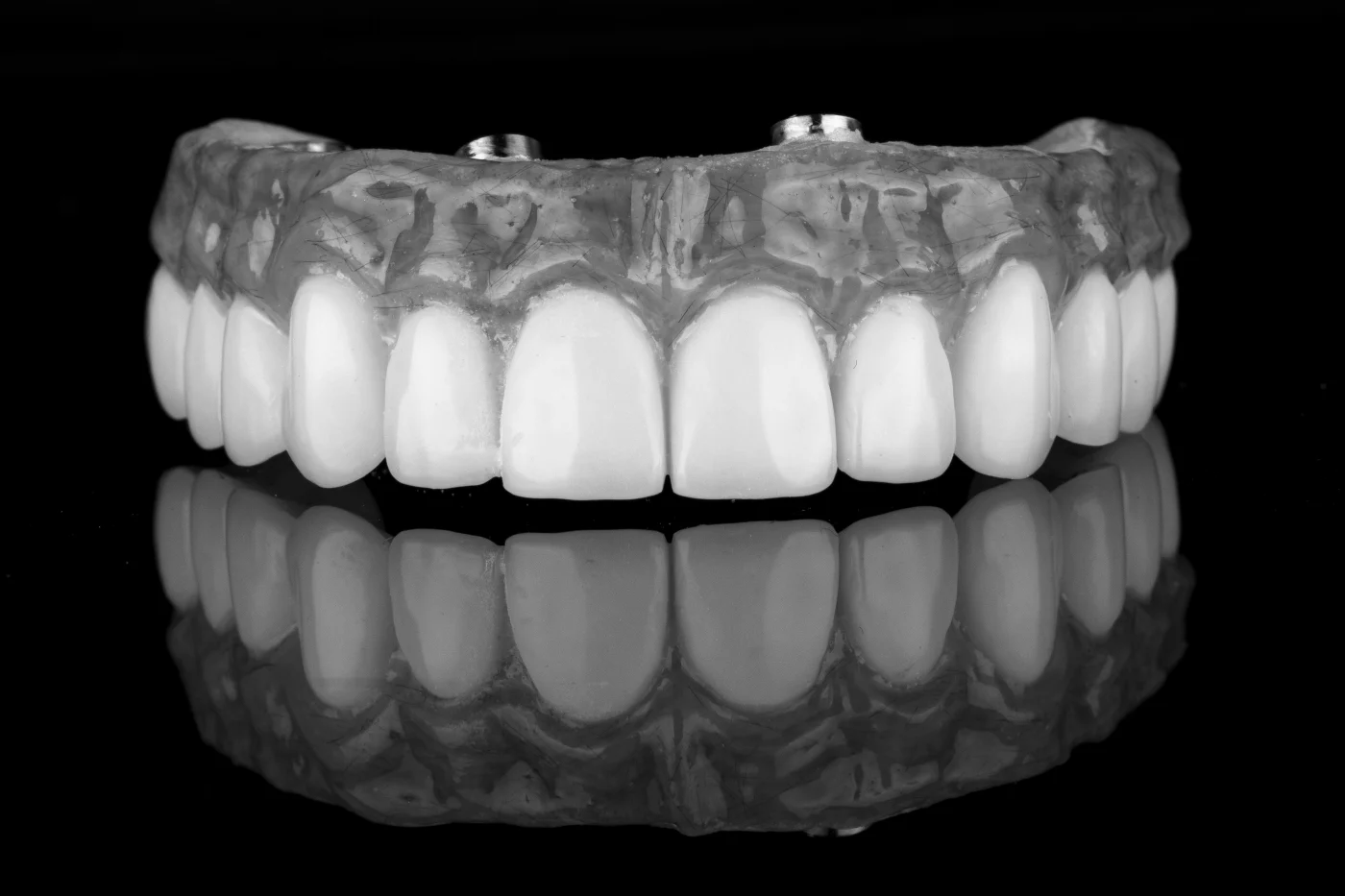 Implantes inmediatos en Albuixech - Clínica Dental Charani