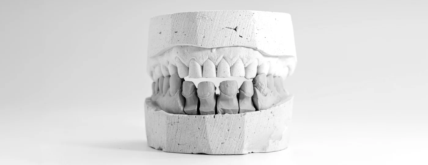 Implantes inmediatos en Albuixech - Clínica Dental Charani