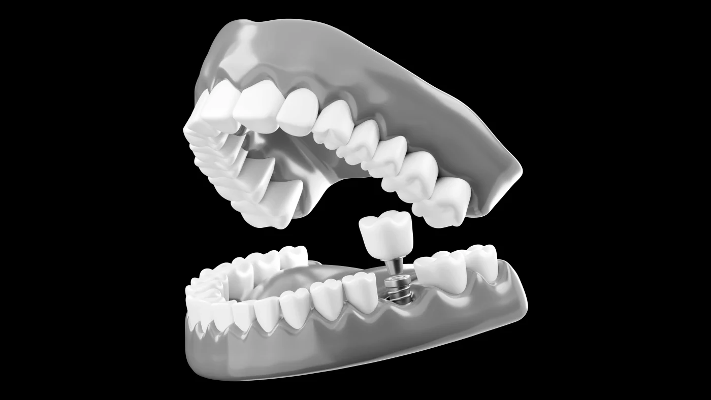 Implantes sin cirugía en Moncada - Clínica Dental Charani