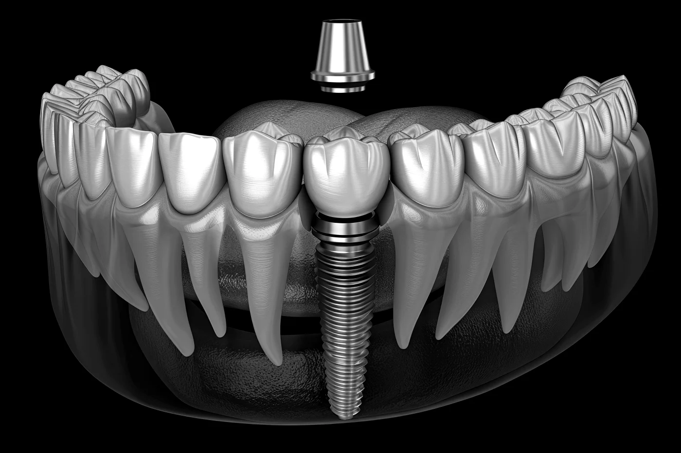 Implantes sin cirugía en Moncada - Clínica Dental Charani