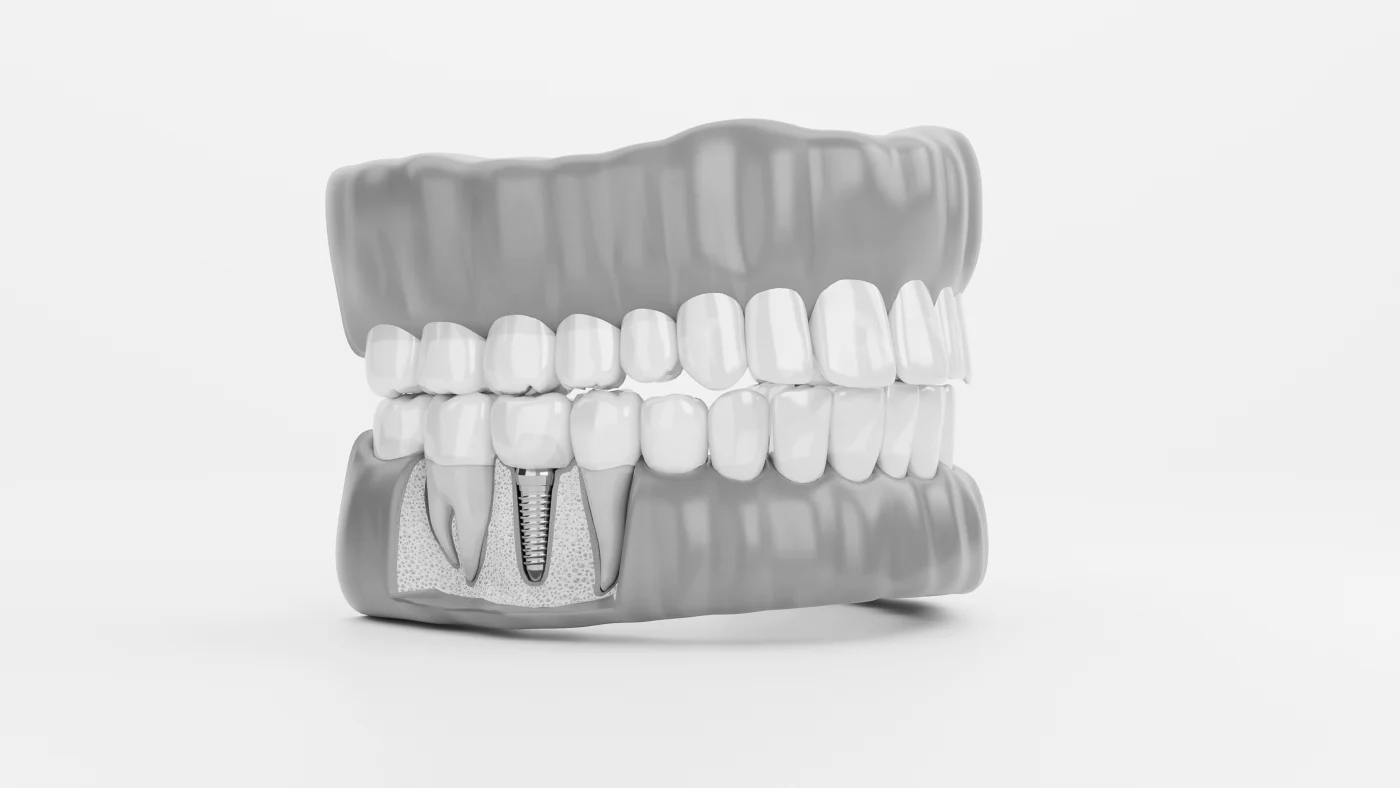 Implantes sin cirugía en Moncada - Clínica Dental Charani