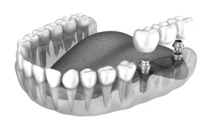 Puentes dentales en Valencia - Clínica Dental Charani